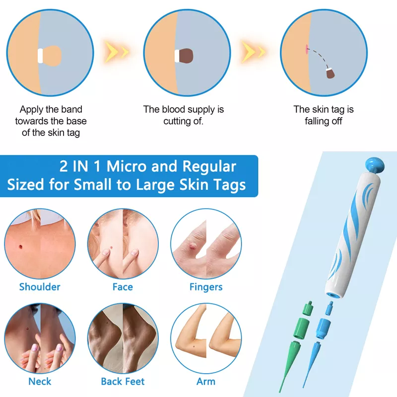 2-in-1 Auto Skin Tag Remover Kit with 40 Bands – Painless Skin Tag & Wart Removal Tool - Image 4